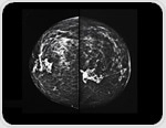 3D mammograms increasing in popularity for breast cancer screening in the USA
