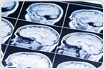 New strategies for preventing and coping with rising burden of brain diseases