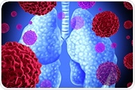 Discovery of distinct lung cancer pathways could help future patients