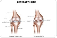 Bursitis and Osteoarthritis Similarities and Differences