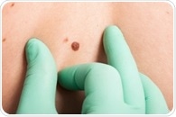 Pioneering melanoma test to be made available within two years