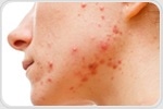 Acne may be a natural, transient inflammatory state when facial skin is exposed to microbes