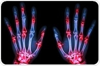 Newly discovered cell involved in rheumatoid arthritis could serve as treatment target