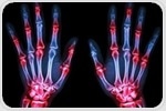 Arginine depletion could form the basis for potential rheumatoid arthritis therapies