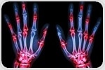 Arginine depletion could form the basis for potential rheumatoid arthritis therapies