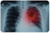 Potential New Metabolic Biomarkers of Lung Cancer Identified with Magnetic Resonance Spectroscopy