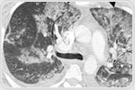 Pulmonary imaging key to diagnosing vaping-related lung damage