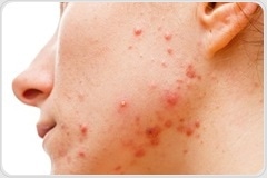 Clinicians urged to reconsider controversial acne treatment