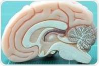 Inflammatory cells arise from local memory cells for advanced multiple sclerosis