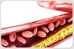 Cholesterol levels are declining in western countries but rising in Asia