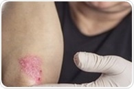 siRNA-based treatment can reduce psoriasis symptoms
