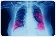 Metastatic Lung Cancer