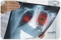 Stages of Lung Cancer