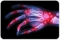 GBP5 protein may play a key role in suppressing inflammation in rheumatoid arthritis