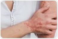 Study explains the link between psoriasis treatment and cardiovascular diseases