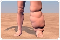 Infrared thermal imaging camera can help monitor the progression of lymphatic filariasis