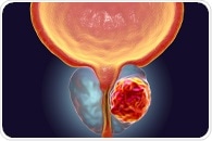Study: A subset of patients with localized prostate cancer may benefit from immunotherapies