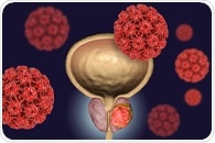 Artificial intelligence program analyzes CT scans for tell-tale signs of prostate cancer