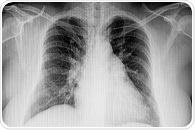 New cardiac rehabilitation intervention improves quality of life in hospitalized heart failure patients