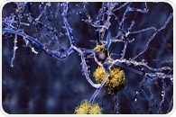 Study finds a link between progression of Alzheimer’s disease and corpuscles in cell nuclei
