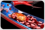 A new guide for cancer-associated thrombosis