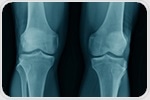 Cultured cartilage cells from the nasal septum could help relieve osteoarthritis in the knee