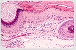 UCLA-developed new "virtual histology" technology may reduce need for skin biopsies