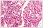 Study reveals key characteristics of immune cells in ovarian cancer