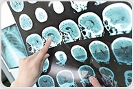 Cognitive rehabilitation found to be effective in treating multiple sclerosis-related cognitive dysfunction
