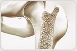 New study provides important insights into osteoporosis