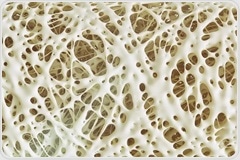 Osteoporosis and Hearing Loss