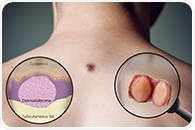 New microbiopsy device could change the way skin cancers are diagnosed