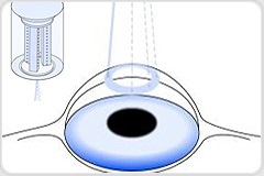 Eye Surgery  Supported by Precision Laser Beam Steering Mirrors