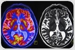 Differences in behavior among people with ASD are closely related to variations in brain anatomy