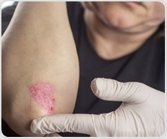 Scientists discover a key starting point for inhibiting inflammation in psoriasis and psoriatic arthritis