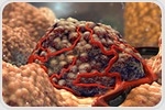 More intensive prostate cancer screening may reduce the risk of metastatic cancer later