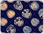 Study implicates gut microbiome health in Parkinson's disease