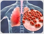 Individuals with autosomal and X-linked recessive deficiency of IRAK-4 and MyD88 are more susceptible to developing hypoxemic COVID-19 pneumonia