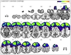 Revolutionary breakthrough in epilepsy treatment: Redesigned brain surgery promises long-term seizure freedom