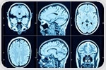 Gout unveiled as surprising culprit in neurodegenerative diseases
