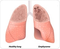 Reseachers use CT scans to track the progression of emphysema over time