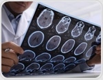 Study examines unimodal vs multimodal neuroimaging methods for classifying psychosis