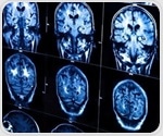 Deep learning system accurately identifies joint space narrowing and erosions in hand radiographs