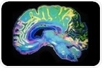 Marijuana's psychoactive compound may alter brain wiring in adolescents