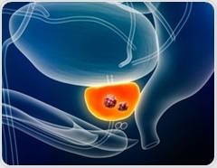 Multi-ancestry study reveals 187 new genetic risk factors for prostate cancer