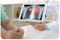 Pioneering study finds predictive biomarker in lung adenocarcinoma