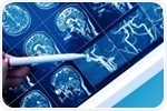 New study highlights urgent need for specific biomarkers in vascular cognitive impairment and dementia diagnosis