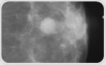 AI-Powered Risk Assessment Mitigates Racial Bias in Breast Cancer Diagnosis