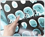Low-dose radiation shows promise as treatment for brain injury and stroke