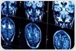 AI can predict short-term and long-term survivors of brain cancer